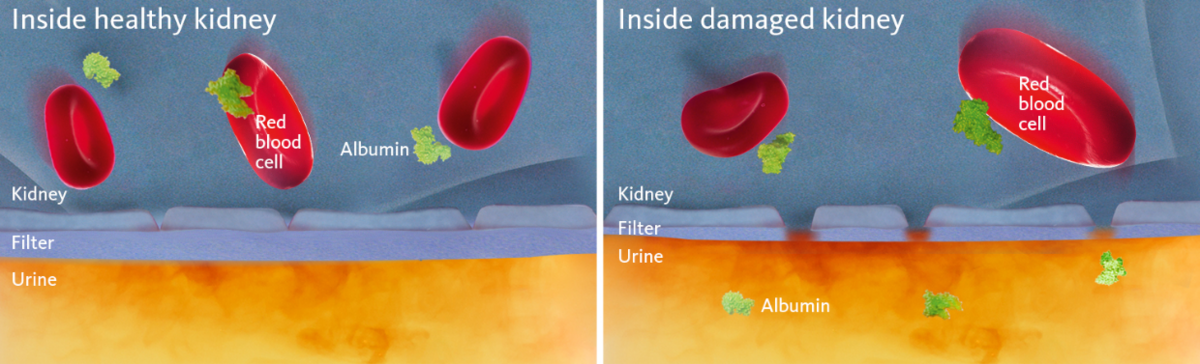 [.ES-pt Spain (portuguese)] •	Schematic and simplified view of a healthy and a damaged kidney membrane with the latter illustrating the cause of albuminuria.